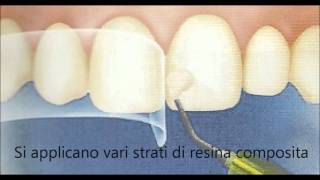 dott Montironi dentista  OTTURAZIONE ESTETICA ANTERIORE  CONSERVATIVA DENTALE [upl. by Adaynek]