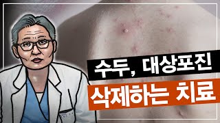 더이상 수두 흉터 때문에 힘들어 하지 마세요 수두흉터대상포진흉터함몰흉터 [upl. by Imuya37]