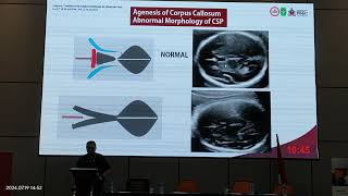 Video 2 Corpus Callosum Diagnosis [upl. by Anwahsiek]