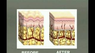 Fat reduction with Injection Lipolysis  Lipodissolve [upl. by Zeralda]