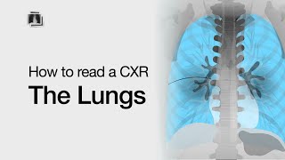 How to Read a Chest XRay The Lungs [upl. by Rossen522]