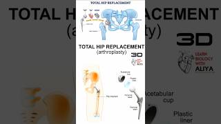 Total Hip Replacement  animation 3d short  learn Biology with Aliya [upl. by Spiers]