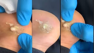 Deep Foot Corn Removal With Callus Was So PAINFUL [upl. by Skiba283]