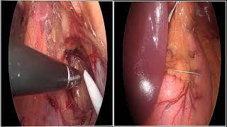 Part 8 LWSK 2024 Hernia Workshop Day 2 Toupet Fundoplication amp TEP [upl. by Corly]