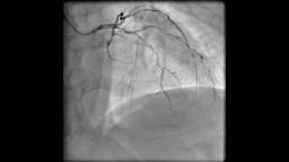 Left coronary angiogram RAO cranial [upl. by Nerol]