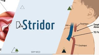 StridorDefinitionTypesMechanism [upl. by Neirad808]