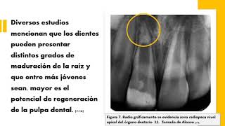 34 Terapia pulpar en dientes permanentes jóvenes con diagnóstico de pulpitis irreversible o necrosi [upl. by Koppel]