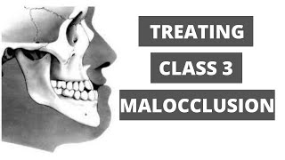 Management of Class 3 Malocclusion Orthodontics [upl. by Audre]