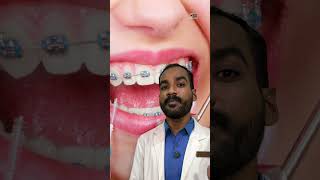 🤷‍♂️Teeth Gap Treatment dentist dentalclinic teethgapmakeover [upl. by Lexi]