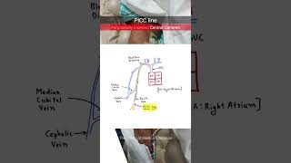 Peripheral Inserted Central Catheter PICC neetpg inicet [upl. by Nahtaoj]