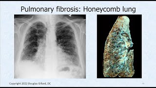 Interstitial Fibrosis amp All About Pathological Auscultatory Breath Sounds Adventitious Sounds [upl. by Ibed]