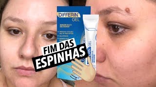 MELHOR TRATAMENTO PARA ACNE QUE JÁ FIZ  DIFFERIN [upl. by Mohl]