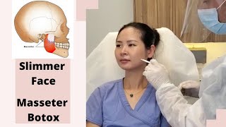 Botox Injections to Masseter Muscles How to get slimmer face [upl. by Essa]