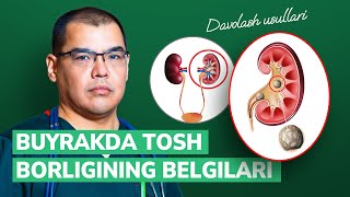 Buyrakda tosh borligining belgilari va davolash usullari [upl. by Symon]