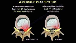 Evaluation of S1 nerve Root motor sensory and reflex evaluation of S1 in contrast to L5 root [upl. by Nnyleuqaj]