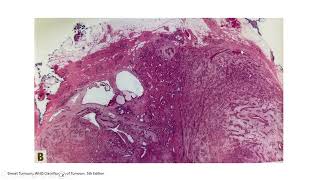 BREASTPATH 20240719 Breast fibroepithelial lesions fibroadenoma phyllodes tumor hamartoma [upl. by Aznerol]