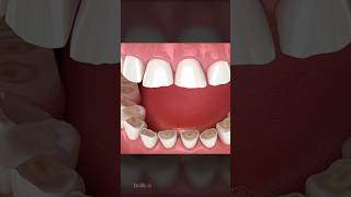 What Is Bruxism and How Is It Treated [upl. by Reaht411]