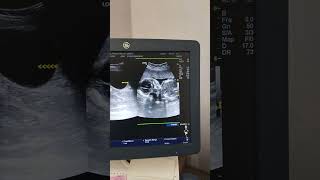 Corpus Luteum Cyst Ultrasound [upl. by Cilegna]