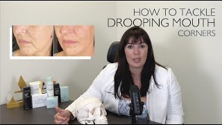 How to Lift Downturned Mouth Corners NonSurgically [upl. by Rebe]