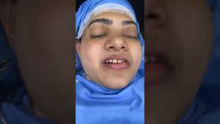 Facial asymmetry correction  hemi facial microsomnia with parry rhomberg’s condition [upl. by Enytsirk262]