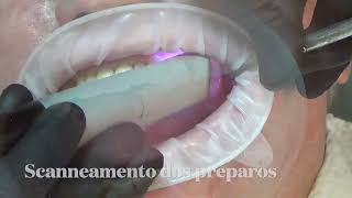 Provisorio sobre dente [upl. by Eintihw924]