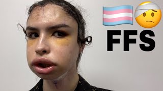 Facial Feminization Surgery  Tyler Brown [upl. by Ferro]