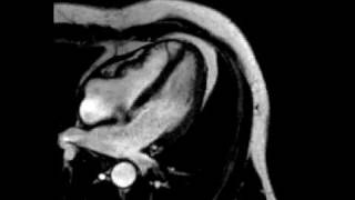 Constrictive pericarditis fourchamber ECGgated cine SSFP MR [upl. by Weirick933]