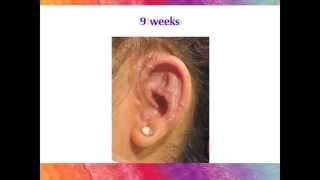 Microtia Ear Surgery  The Healing Process with the Porous Implant Ear Reconstruction technique [upl. by Aihceyt]