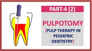 PULPOTOMY PART 42 PULP THERAPY PEDODONTICS PARTIAL PULPOTOMY FORMOCRESOL dentalcafe4331 [upl. by Ches]