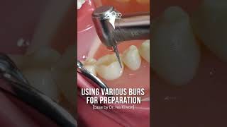 Using Various Burs for Preparation dentalbean [upl. by Assiroc]