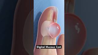 Digital mucous cyst explained 3D Animation [upl. by Tomkin436]