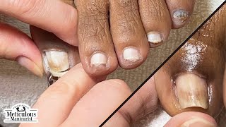 How to Fix Ingrown Toenails at Home nails satisfying [upl. by Lladnek]