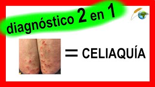 Dermatitis Herpetiforme DIAGNOSTICO amp DIAGNOSTICO DIFERENCIAL  fotos Inmunofluorescencia directa [upl. by Olegnad327]