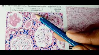 Chronic Pyelonephritis Revision MBBS PATHOLOGY [upl. by Nashbar326]