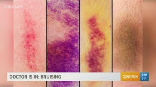 Why bruising matters and what the purple blue and yellow marks can indicate [upl. by Osnofedli]