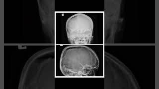 TENSION PNEUMOCAPHLOUS pneumo brain ctscan [upl. by Ahswat]