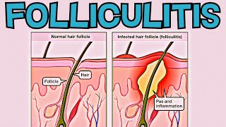 What is Folliculitis Folliculitis EXPLAINED in 2 Minutes  Signs Symptoms Cause Treatment [upl. by Lora338]