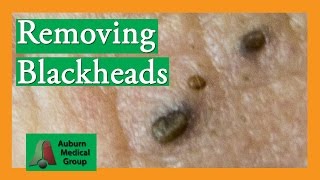 Several Blackheads  Auburn Medical Group [upl. by Maurili348]