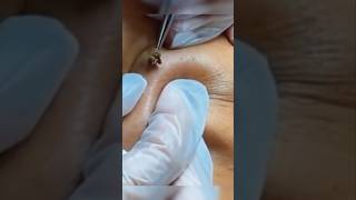 😬 Grosse extraction choc acne blackheads blackheadremoval [upl. by Atnuahc772]