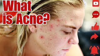 The truth behind these pesky pimples skincare acne breakouts [upl. by Baugh879]