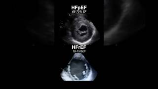 Echocardiogram HFpEF vs HFrEF radiology cardiology [upl. by Arihaz]