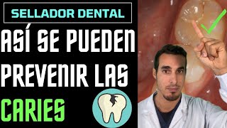 Cómo PREVENIR las CARIES en NIÑOS  SELLADORES de fosetas y FISURAS [upl. by Sisenej715]