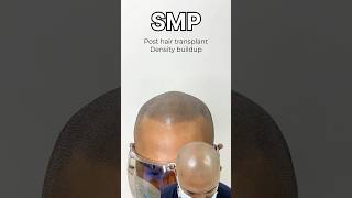 Scalp micropigmentation ✅ hair transplant failure ❌ scalpmicropigmentationindia smp [upl. by Anerbes39]