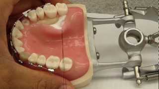 Palatal Flap Elevation Assistance  Connective tissue graftCrown Lengthening [upl. by Ajak736]