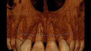 Horizontal Root Fracture Retreatment [upl. by Arval]