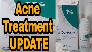 Acne Treatment Using Clindamycin phosphate Topical Solution  Update after 1 month of treatment [upl. by Izmar]