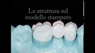 Stampa 3D di modelli dentali [upl. by Alesandrini]