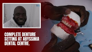 StepbyStep Guide to Complete Denture Setting Procedure [upl. by Radu]