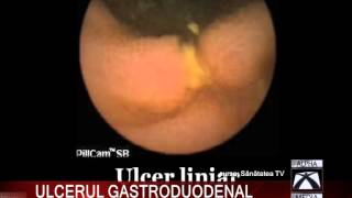 ULCERUL GASTRODUODENAL [upl. by Baum]