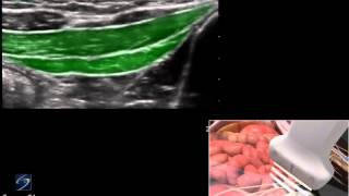 3D How To Ultrasound Guided Ilioinguinal and Iliohypogastric Nerve Block  SonoSite Ultrasound [upl. by Festa482]